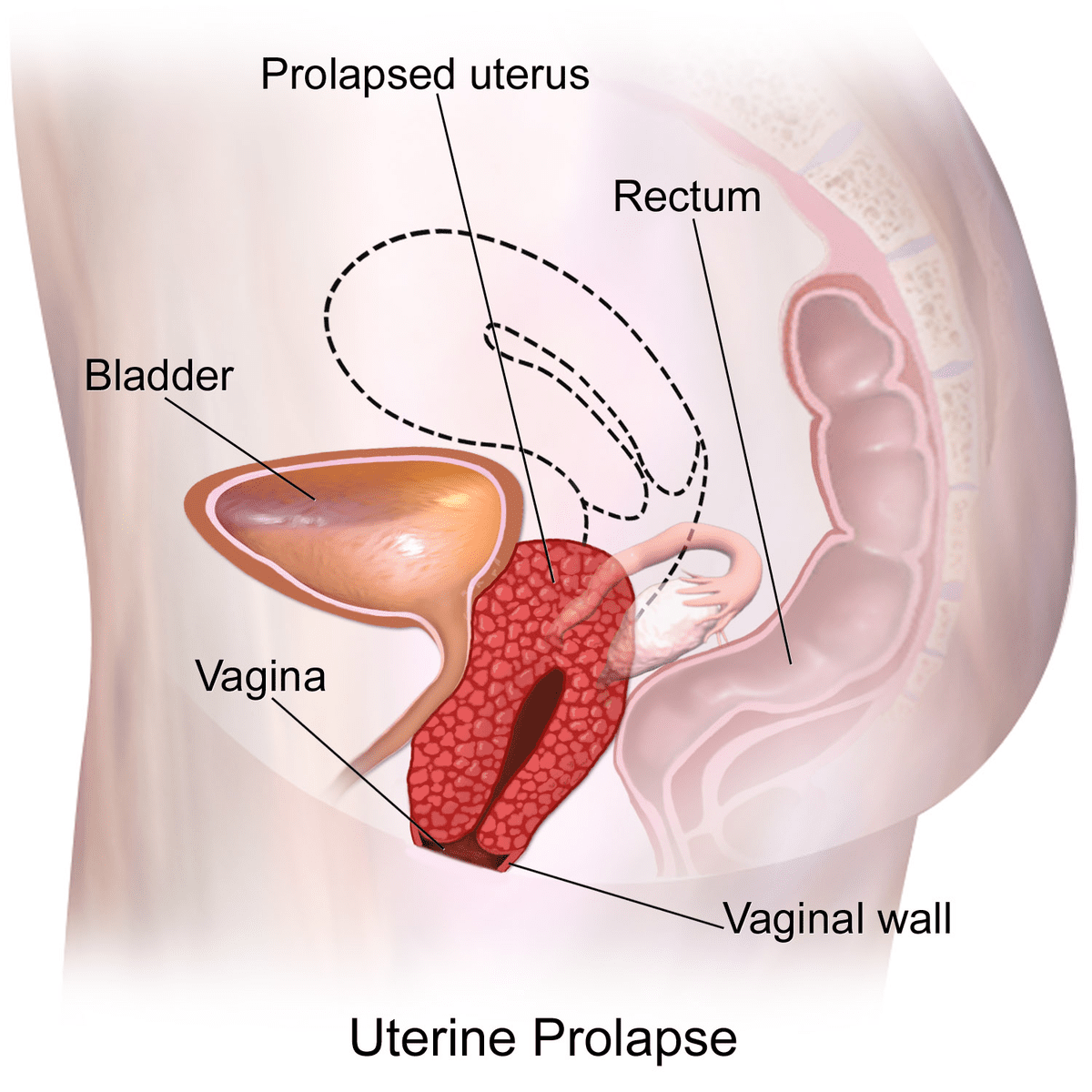 Pelvic Organ Prolapse