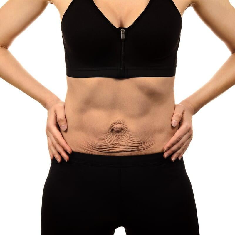 Diastasis Recti and Posture