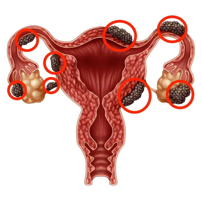 Managing Endometriosis with Pelvic Physiotherapy